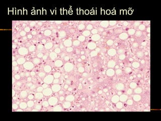 Hình ảnh vi thể thoái hoá mỡ
 
