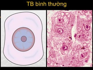 TB bình thường
 