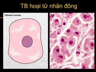 TB hoại tử nhân đông
 
