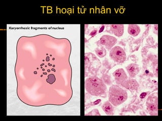 TB hoại tử nhân vỡ
 