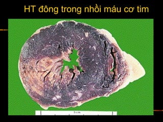 HT đông trong nhồi máu cơ tim
 