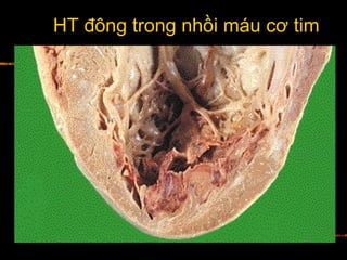 HT đông trong nhồi máu cơ tim
 