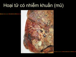Hoại tử có nhiễm khuẩn (mủ)
 