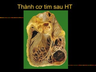 Thành cơ tim sau HT
 