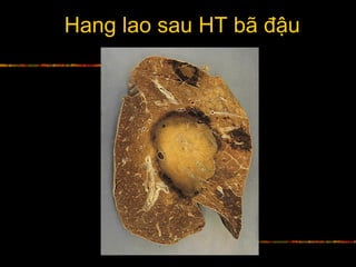 Hang lao sau HT bã đậu
 