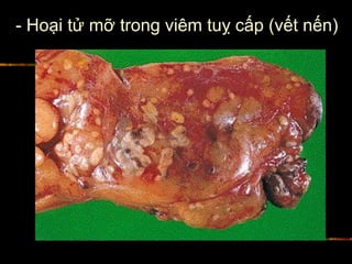 - Hoại tử mỡ trong viêm tuỵ cấp (vết nến)
 