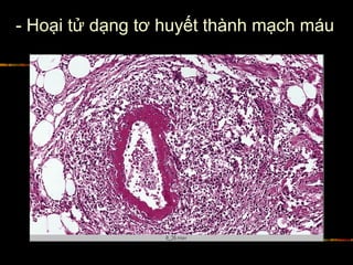 - Hoại tử dạng tơ huyết thành mạch máu
 