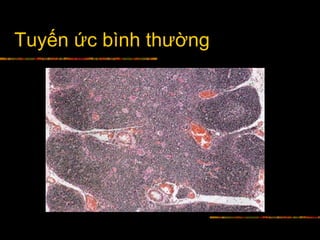 Tuyến ức bình thường
 
