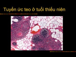 Tuyến ức teo ở tuổi thiếu niên
 