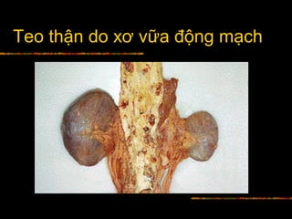 Teo thận do xơ vữa động mạch
 