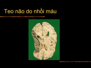 Teo não do nhồi máu
 