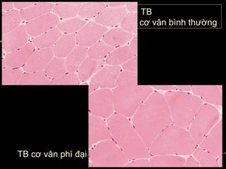 TB
cơ vân bình thường
TB cơ vân phì đại
 