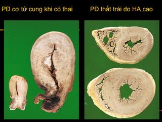 PĐ cơ tử cung khi có thai PĐ thất trái do HA cao
 