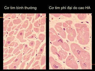 Cơ tim bình thường Cơ tim phì đại do cao HA
 