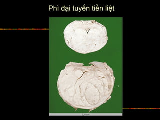 Phì đại tuyến tiền liệt
 