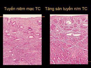 Tuyến niêm mạc TC Tăng sản tuyến n/m TC
 