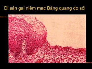 Dị sản gai niêm mạc Bàng quang do sỏi
 