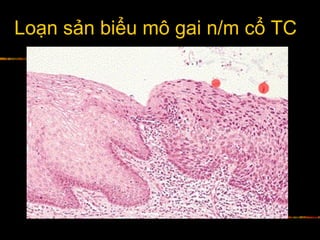 Loạn sản biểu mô gai n/m cổ TC
 