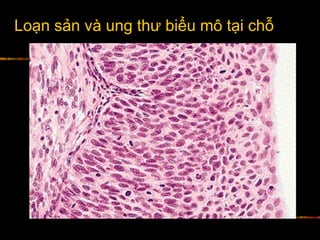 Loạn sản và ung thư biểu mô tại chỗ
 