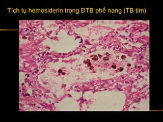 Tích tụ hemosiderin trong ĐTB phế nang (TB tim)
 