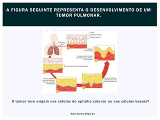 A F I G URA S E GUI NTE R E P RESENTA O D E SE NVOLVIME NTO D E U M
                         T UMOR P U LMONA R.




  O tumor teve origem nas células do epitélio colunar ou nas células basais?


                                 Nuno Correia 2012/13
 