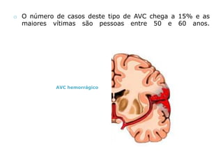 Tratamento do acidente vascular cerebral agudo;
