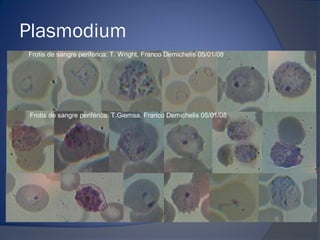 Plasmodium
Frotis de sangre periférica: T. Wright, Franco Demichelis 05/01/08
Frotis de sangre periférica: T.Giemsa, Franco Demichelis 05/01/08
 