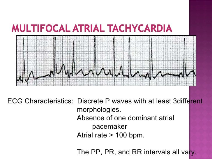 ECG: Multifocal Atrial...