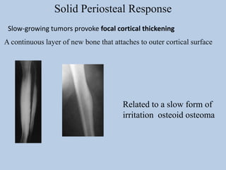Solid Periosteal Response
 Slow-growing tumors provoke focal cortical thickening
A continuous layer of new bone that attaches to outer cortical surface




                                       Related to a slow form of
                                       irritation osteoid osteoma
 