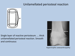Unilamellated periosteal reaction




Single layer of reactive periosteum. … thick
unilamellated periosteal reaction. Smooth
and continuous

                                               Hypertrophic osteoarthropathy
 
