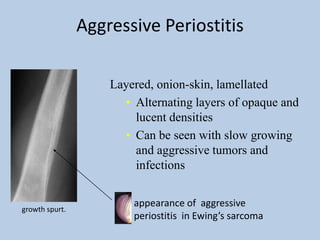 Aggressive Periostitis

                    Layered, onion-skin, lamellated
                      • Alternating layers of opaque and
                        lucent densities
                      • Can be seen with slow growing
                        and aggressive tumors and
                        infections


                        appearance of aggressive
growth spurt.
                        periostitis in Ewing’s sarcoma
 