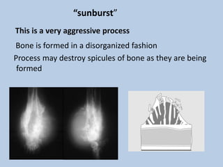 “sunburst”
This is a very aggressive process
Bone is formed in a disorganized fashion
Process may destroy spicules of bone as they are being
 formed
 