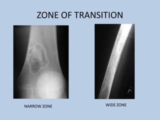 ZONE OF TRANSITION




NARROW ZONE       WIDE ZONE
 