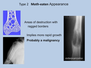 Type 2 Moth-eaten Appearance




  Areas of destruction with
    ragged borders

    Implies more rapid growth
    Probably a malignancy




                                osteosarcoma
 
