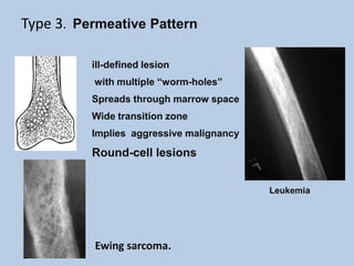 Type 3. Permeative Pattern

          ill-defined lesion
          with multiple “worm-holes”
          Spreads through marrow space
          Wide transition zone
          Implies aggressive malignancy

          Round-cell lesions


                                          Leukemia




          Ewing sarcoma.
 