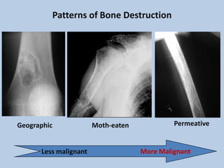 Patterns of Bone Destruction




Geographic             Moth-eaten            Permeative


      Less malignant                More Malignant
 