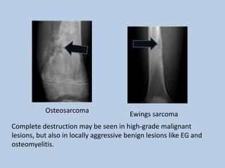 Osteosarcoma                 Ewings sarcoma
Complete destruction may be seen in high-grade malignant
lesions, but also in locally aggressive benign lesions like EG and
osteomyelitis.
 