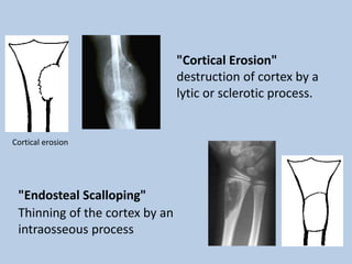 "Cortical Erosion"
                                destruction of cortex by a
                                lytic or sclerotic process.


Cortical erosion




 "Endosteal Scalloping"
 Thinning of the cortex by an
 intraosseous process
 