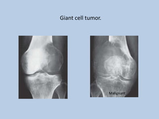Giant cell tumor.




                    Malignant
 