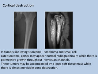 Cortical destruction




In tumors like Ewing's sarcoma, lymphoma and small cell
osteosarcoma, cortex may appear normal radiographically, while there is
permeative growth throughout Haversian channels.
These tumors may be accompanied by a large soft tissue mass while
there is almost no visible bone destruction.
 