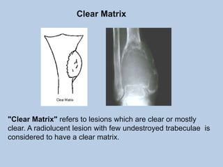 Clear Matrix




"Clear Matrix" refers to lesions which are clear or mostly
clear. A radiolucent lesion with few undestroyed trabeculae is
considered to have a clear matrix.
 