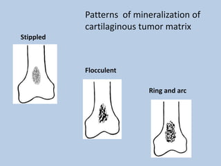 Patterns of mineralization of
           cartilaginous tumor matrix
Stippled



           Flocculent

                           Ring and arc
 