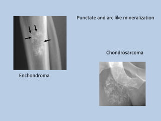 Punctate and arc like mineralization




                           Chondrosarcoma



Enchondroma
 