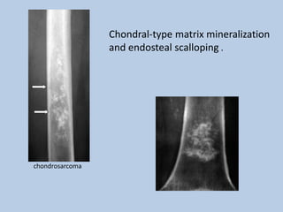 Chondral-type matrix mineralization
                 and endosteal scalloping .




chondrosarcoma
 