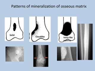 Patterns of mineralization of osseous matrix




Solid
               Cloudlike       Ivory-like
                               opacity
 