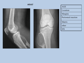 ADULT
        AGE
        Location
        Margins
        Periosteal reaction

        Matrix
        other
        DX
 