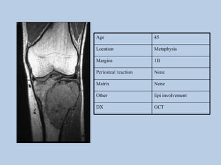 Age                   45

Location              Metaphysis

Margins               1B

Periosteal reaction   None

Matrix                None

Other                 Epi involvement

DX                    GCT
 