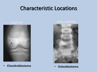 Characteristic Locations

    Epiphysis             Spine, posterior




• Chondroblastoma        • Osteoblastoma
 