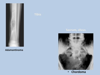 Tibia



                       Sacrum, clivus




Adamantinoma




                        • Chordoma
 