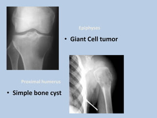 Epiphyses

                       • Giant Cell tumor




    Proximal humerus

• Simple bone cyst
 